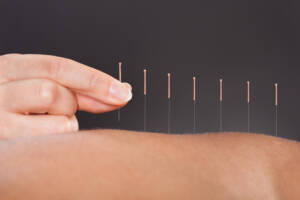 Acupuncture needles